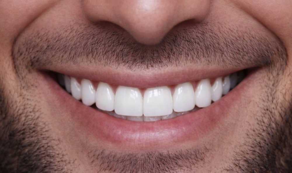 dental-veneers-clinic-near-dubai-marina-for-a-perfect-smile-big-0