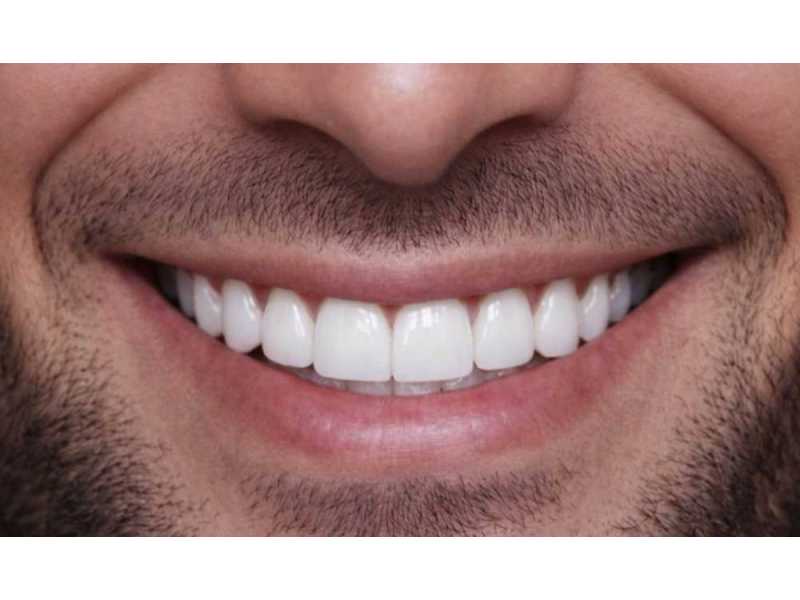 dental-veneers-clinic-near-dubai-marina-for-a-perfect-smile-small-0