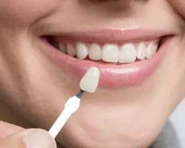 best-veneers-in-dubai