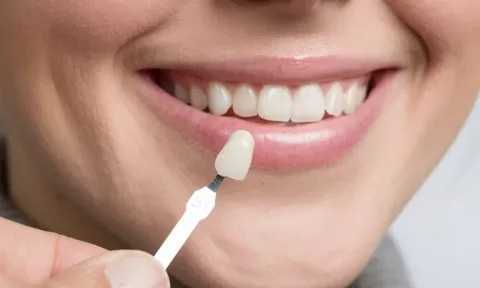 best-veneers-in-dubai-big-0