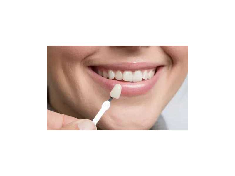 best-veneers-in-dubai-small-0