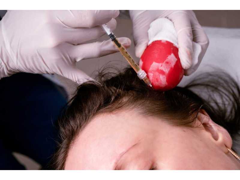 top-benefits-of-getting-prp-treatment-in-dubai-small-0