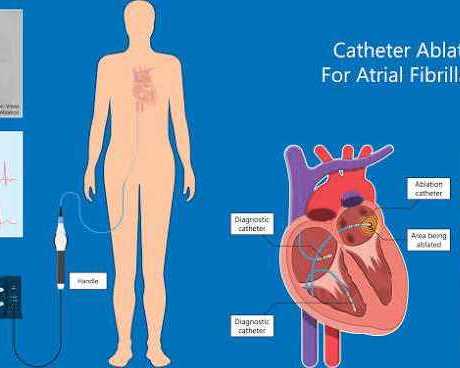 advanced-atrial-fibrillation-ablation-treatment