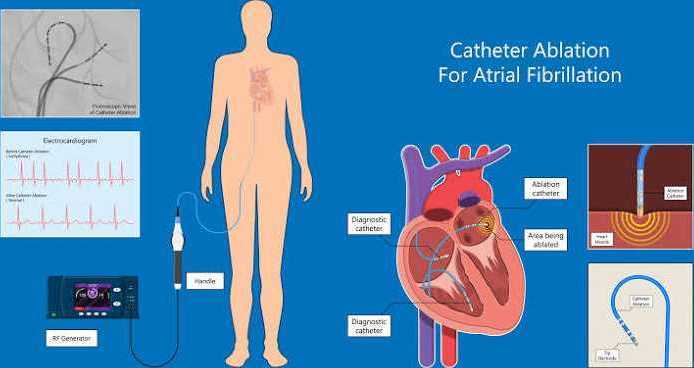 advanced-atrial-fibrillation-ablation-treatment-big-0