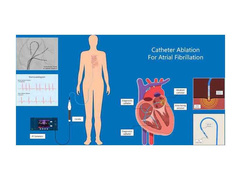 advanced-atrial-fibrillation-ablation-treatment-small-0