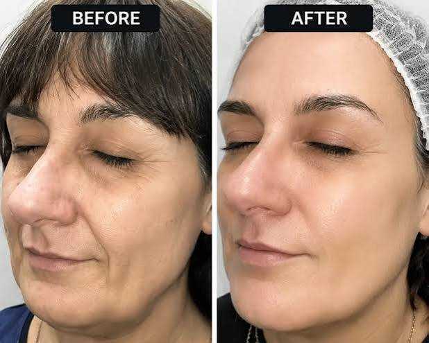 fotona-4d-facelift-in-dubai-non-surgical-skin-rejuvenation-big-0