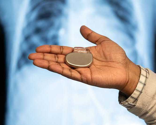 pacemaker-treatment-by-dr-moutaz-el-kadri