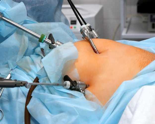 laparoscopic-hernia-treatment-and-surgery-in-abu-dhabi