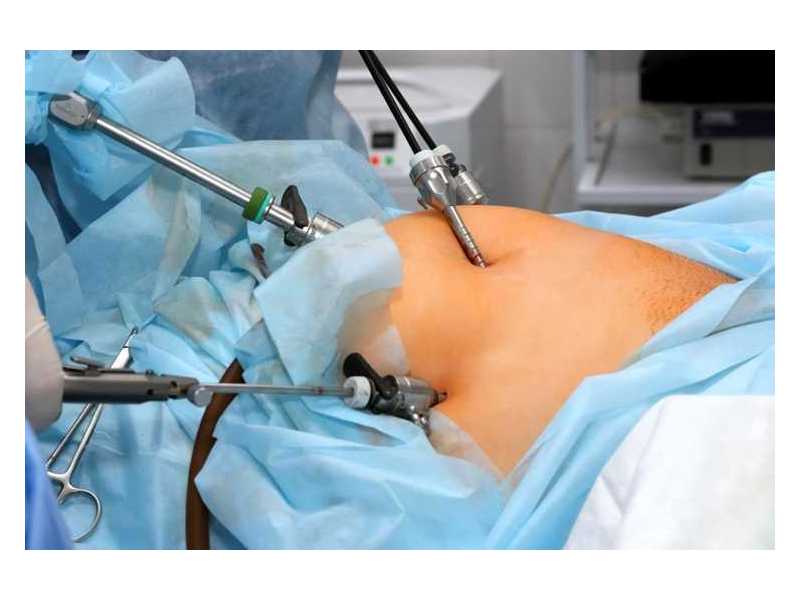 laparoscopic-hernia-treatment-and-surgery-in-abu-dhabi-small-0