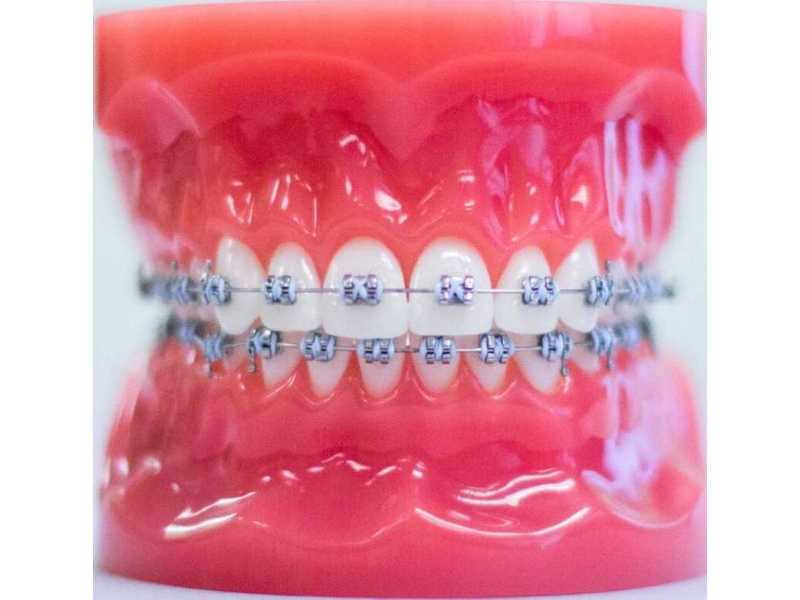 tmj-disorder-treatment-by-top-orthodontist-specialist-in-dubai-small-1