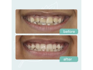 Affordable Tooth Implant in Dubai