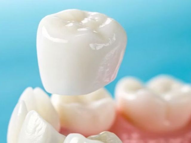 dental-crowns-in-port-macquarie-mid-north-coast-dental-centres