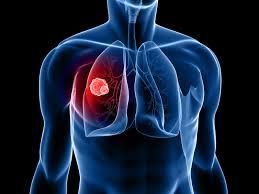 lung-cancer-in-craigieburn