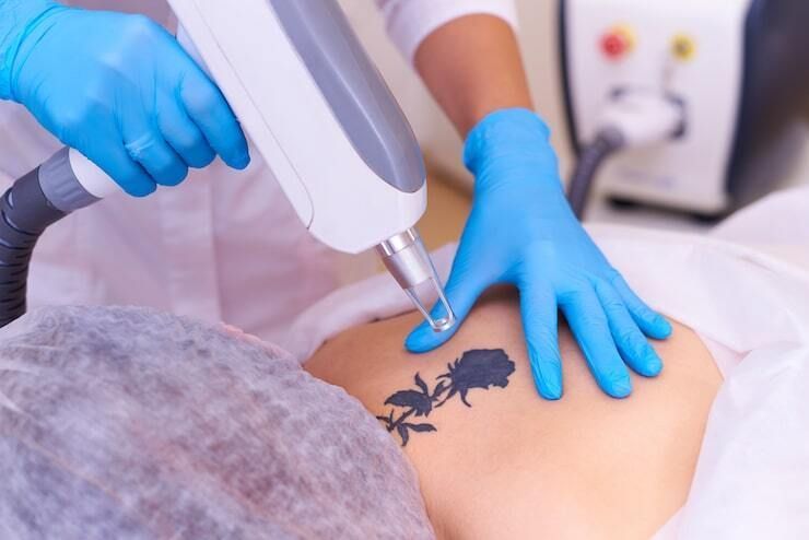 best-laser-tattoo-removal-in-sydney-big-0