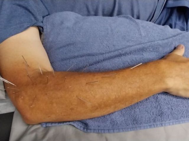 dry-needling-near-me-reduce-muscle-tension-strength-clinic