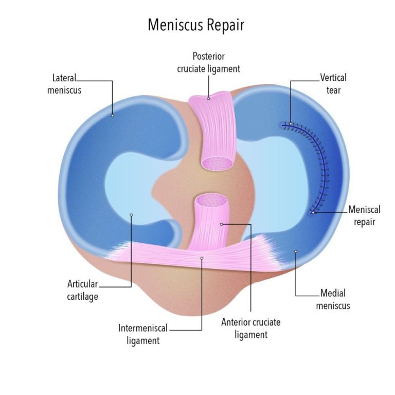 ease-knee-pain-with-reliable-meniscal-repair-big-0