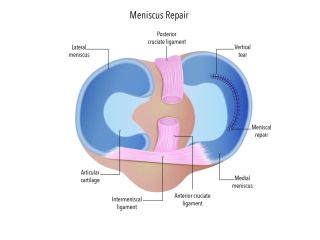 ease-knee-pain-with-reliable-meniscal-repair-small-0