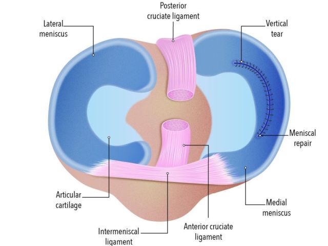ease-knee-pain-with-reliable-meniscal-repair