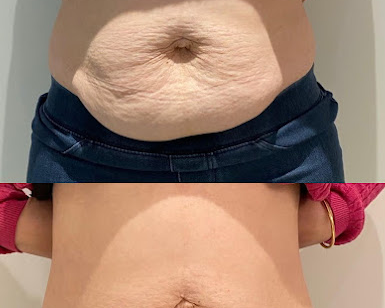 best-body-contouring-clinic-in-berwick