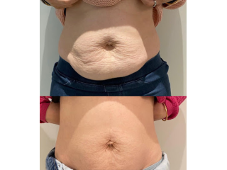 best-body-contouring-clinic-in-berwick-small-0