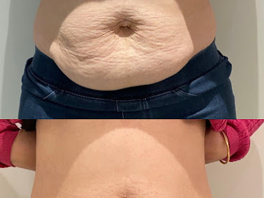 best-body-contouring-clinic-in-berwick