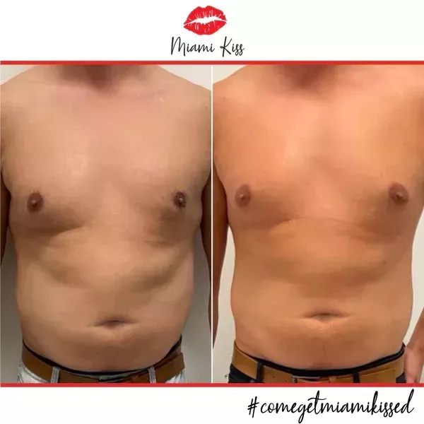 body-fat-freezing-in-varsity-lakes-nearby-suburbs-big-2