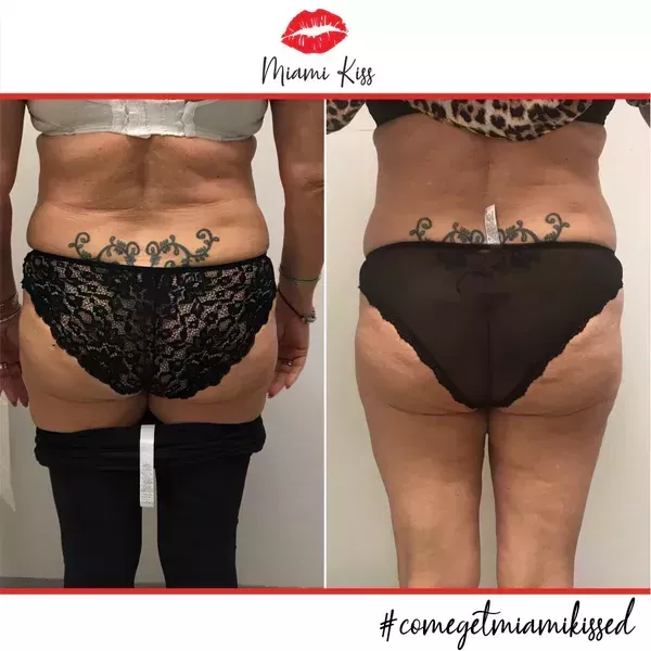 body-fat-freezing-in-varsity-lakes-nearby-suburbs-big-3