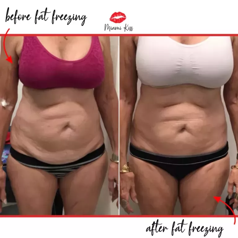 body-fat-freezing-in-varsity-lakes-nearby-suburbs-big-1