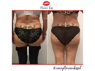 body-fat-freezing-in-varsity-lakes-nearby-suburbs-small-3