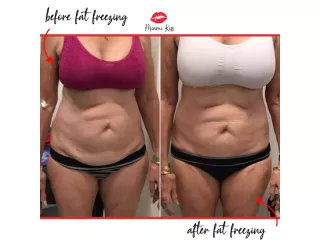 body-fat-freezing-in-varsity-lakes-nearby-suburbs-small-1