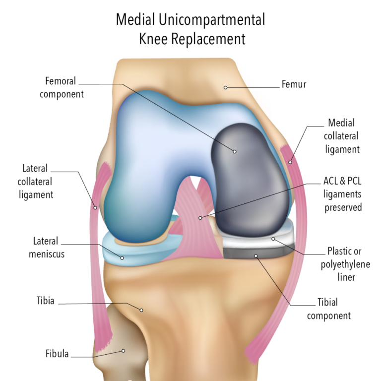 move-more-comfortably-with-partial-knee-surgery-big-0