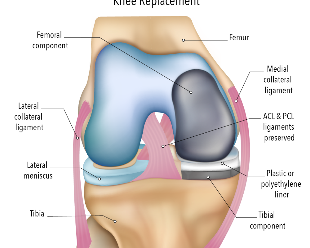 move-more-comfortably-with-partial-knee-surgery
