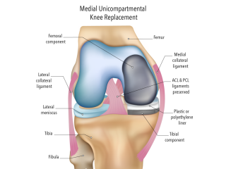 move-more-comfortably-with-partial-knee-surgery-small-0