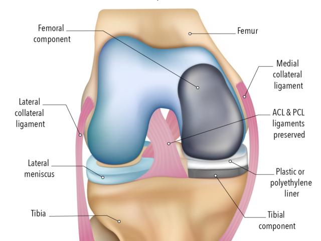 move-more-comfortably-with-partial-knee-surgery