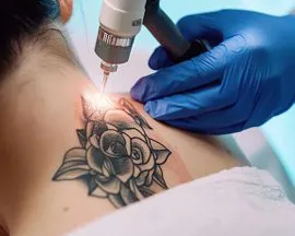 flawless-ink-removal-at-amora-skin-beauty