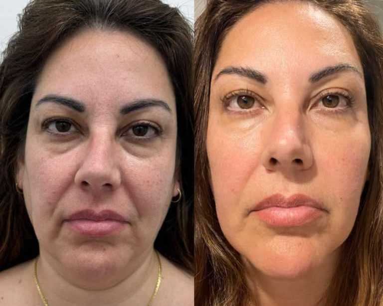 hifu-facial-near-me-in-melbourne-cosmetic-tattooing-melbourne