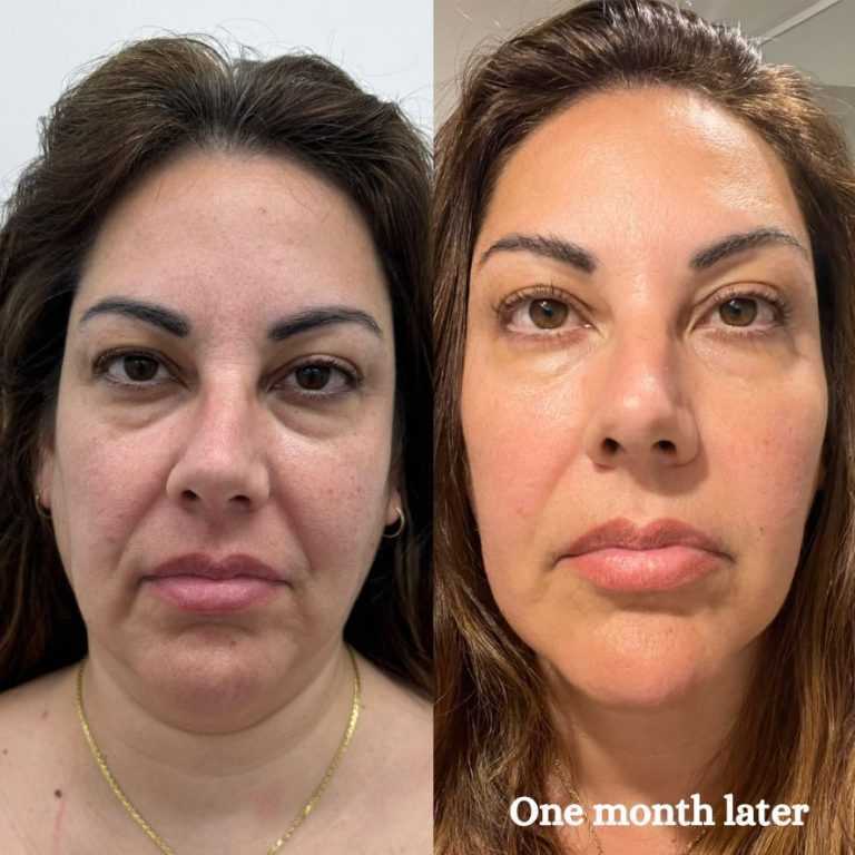 hifu-facial-near-me-in-melbourne-cosmetic-tattooing-melbourne-big-0