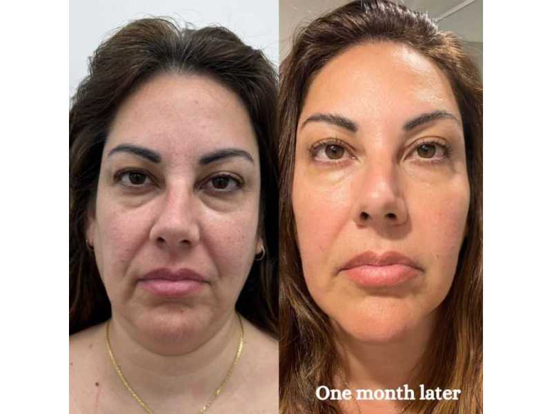 hifu-facial-near-me-in-melbourne-cosmetic-tattooing-melbourne-small-0