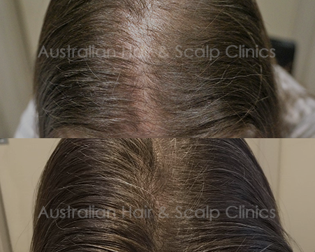 reliable-hair-loss-solutions-in-gold-coast-for-superior-results