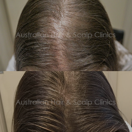 reliable-hair-loss-solutions-in-gold-coast-for-superior-results-big-0