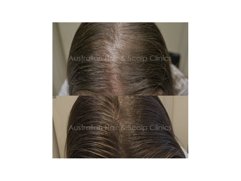 reliable-hair-loss-solutions-in-gold-coast-for-superior-results-small-0