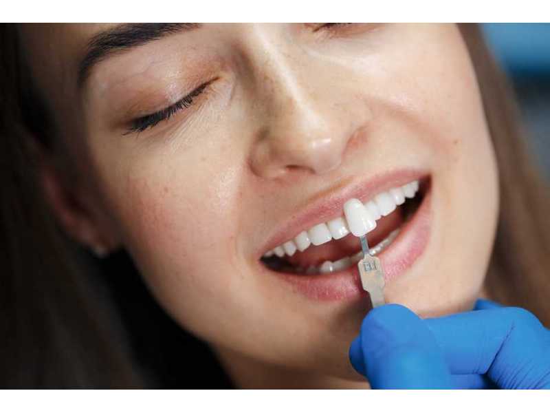custom-veneers-in-port-kennedy-qvc-dental-small-0
