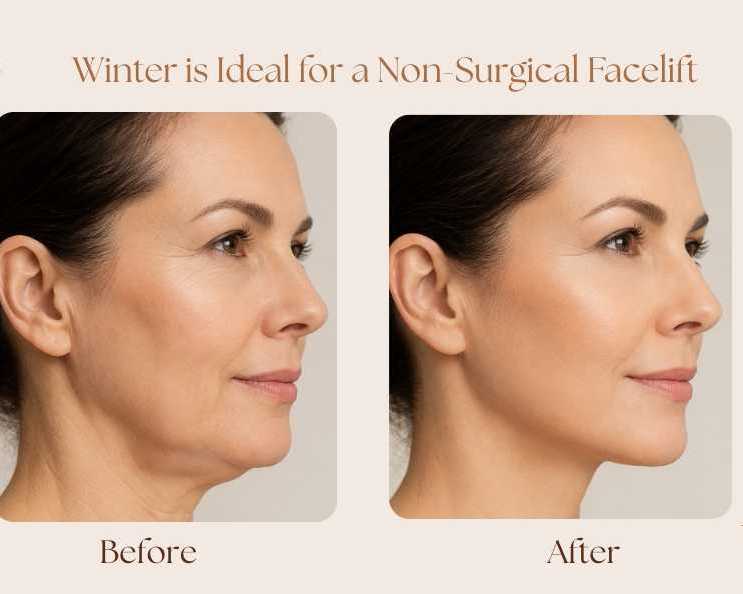 why-winter-is-ideal-for-a-non-surgical-facelift-in-sydney