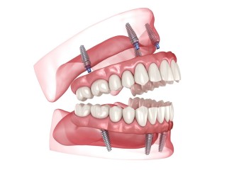 Smile Renewed: All-On-4 Dental Solution