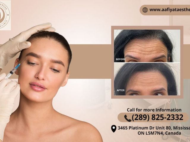 best-botox-clinic-botox-treatment-in-mississauga-on