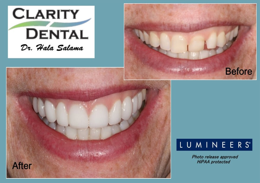 teeth-filling-for-cavities-clarity-dental-big-0