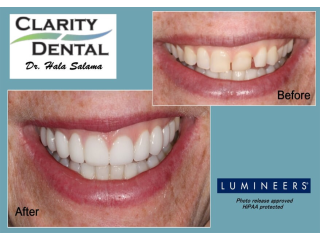 teeth-filling-for-cavities-clarity-dental-small-0
