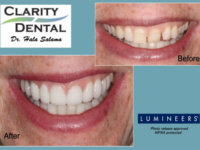 teeth-filling-for-cavities-clarity-dental