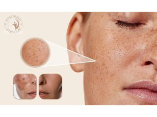 hyperpigmentation-even-tone-treatment-mississauga-aafiyat-small-0