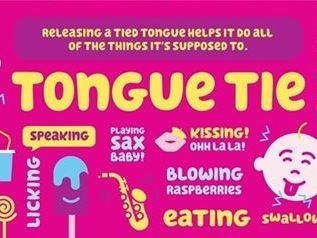 laser-tongue-lip-tie-treatment-for-kids-smile-squad